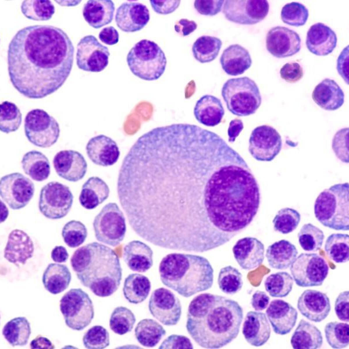 Myeloma cells.