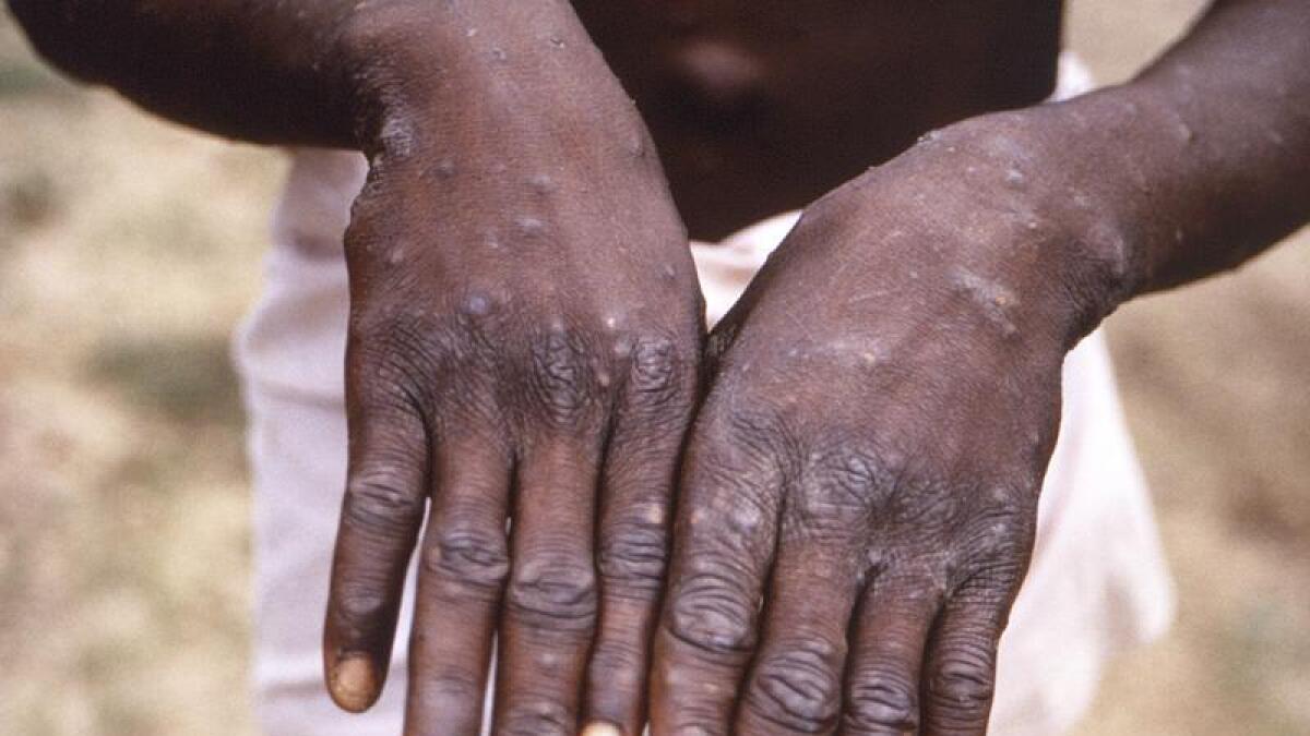 A file photo showing the hands of a monkeypox patient